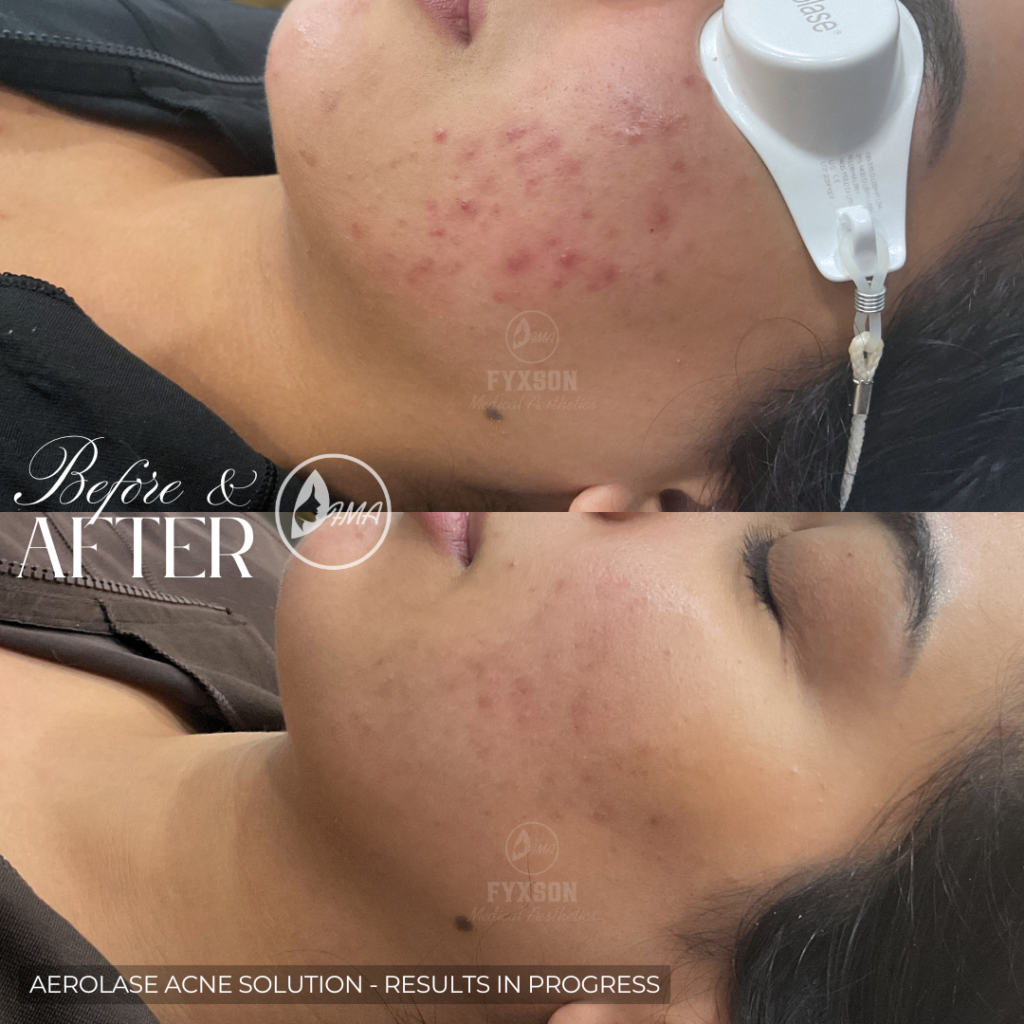 AEROLASE + mICRONEEDLING CUSTOM ACNE TREATMENT
