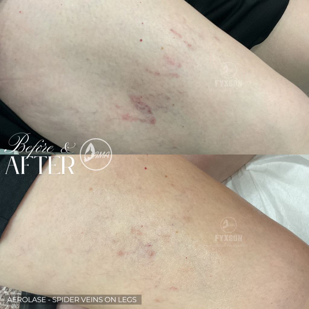 Aerolase - SPIDER VEINS ON LEGS