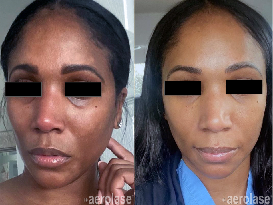 Melasma - LaMone MedSpa