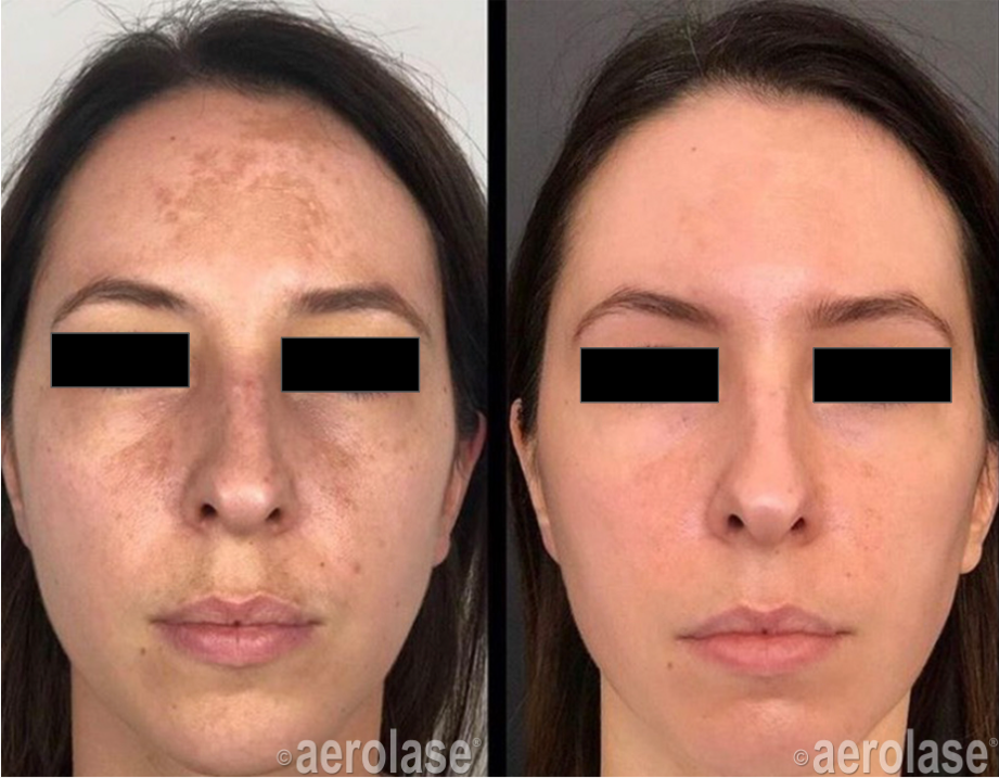 Melasma - One Treatment - Avanti Aesthetic Academy