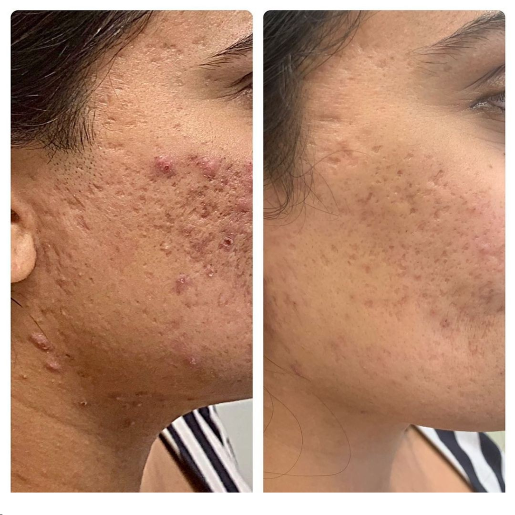 Neo Elite® - Acne (23)