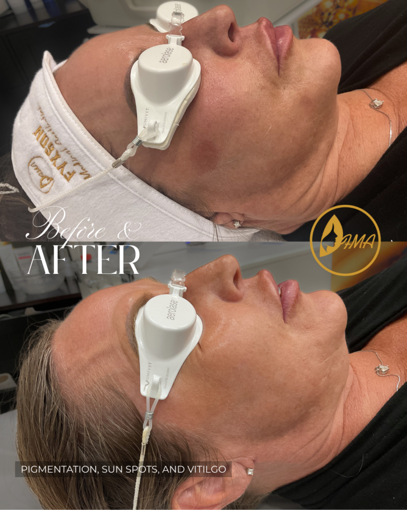 PIGMENT, SUN SPOTS AND VITILGO