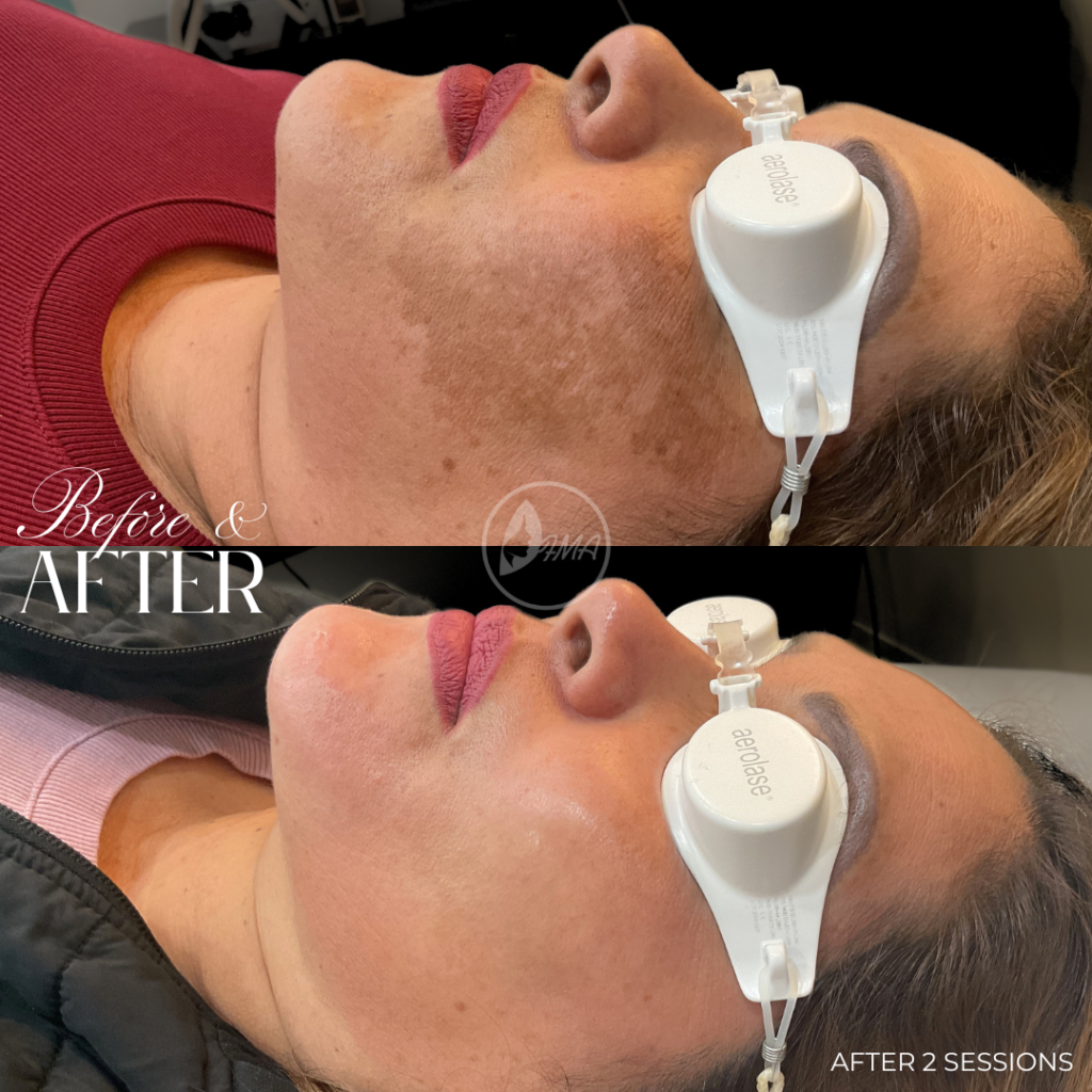 RESULTS AFTER ONLY 2 AEROLASE SESSIONS