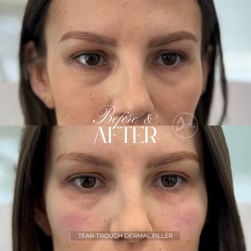 TEAR TROUGH dermal filler