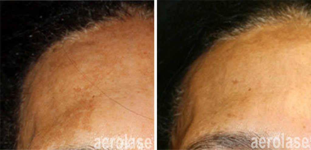aerolase-neoskin-melasma-after-1-treatment-combined-with-tca-peel-cheryl-burgess