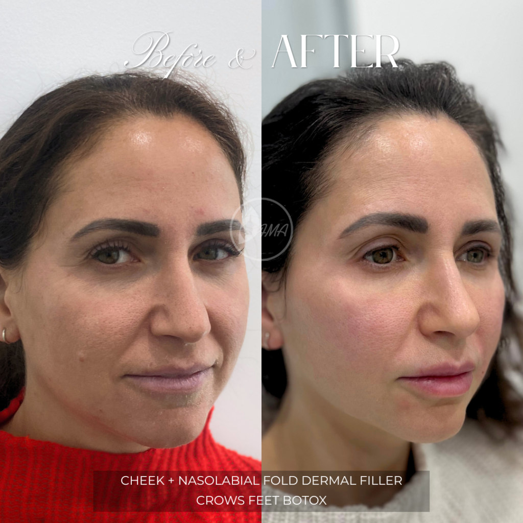 cheek + nasolabial fold dermal filler