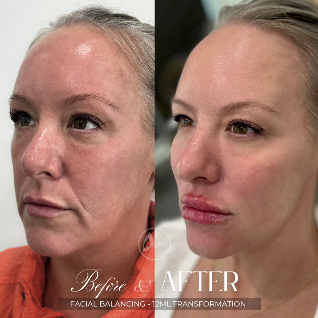 facial balancing using 12ml filler-2